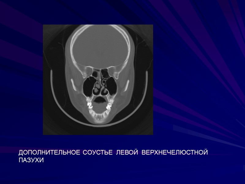 ДОПОЛНИТЕЛЬНОЕ СОУСТЬЕ  ЛЕВОЙ  ВЕРХНЕЧЕЛЮСТНОЙ ПАЗУХИ